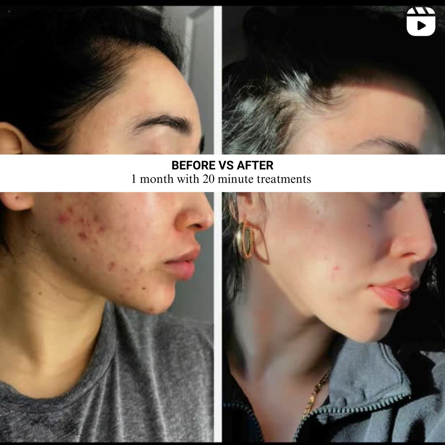 Advanced Micro-LED Light Therapy Mask